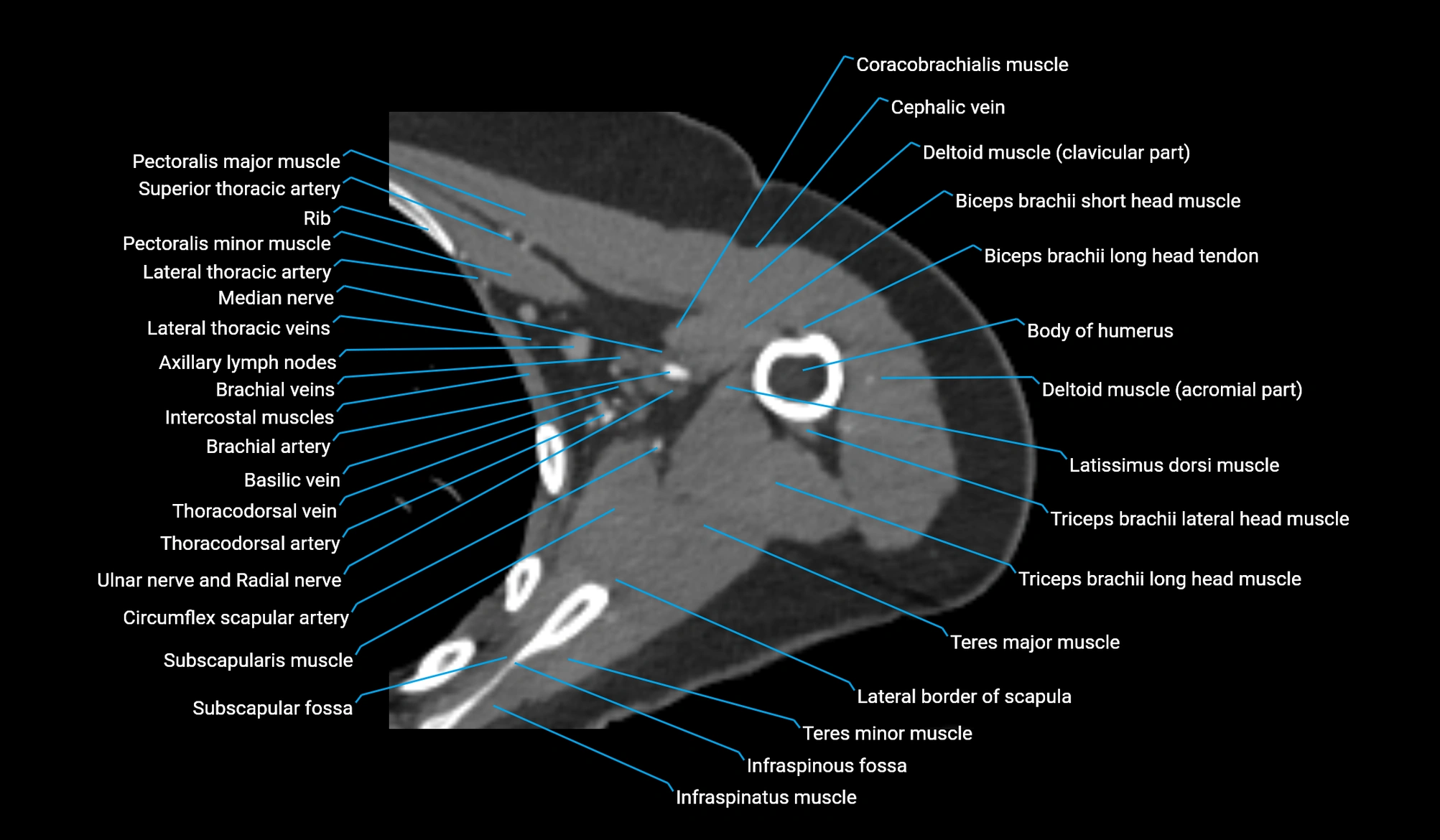 CT upper arm axial  cross sectional anatomy labelled radiology image -00138.webp
